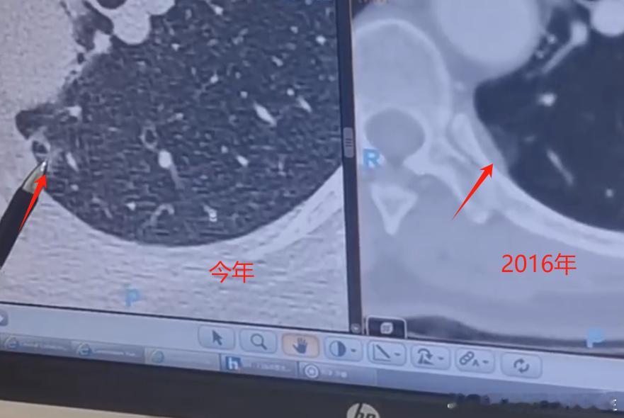 【8mm肺结节，6年不管不顾，会怎么样？】她是幸运的，但却值得警醒。8mm肺结节