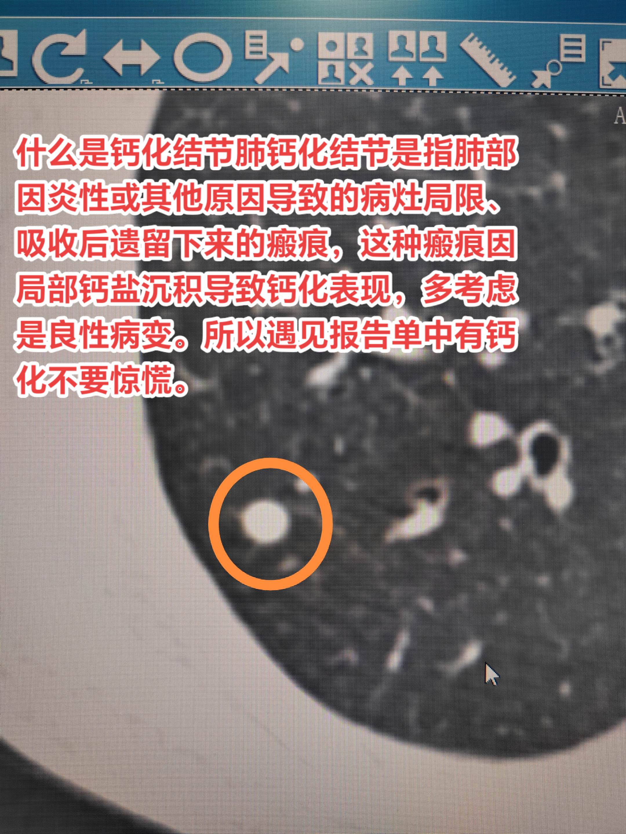 肺肺钙化结节可怕😱？肺钙化结节是指肺部因炎性或其他原因导致的病灶局限...