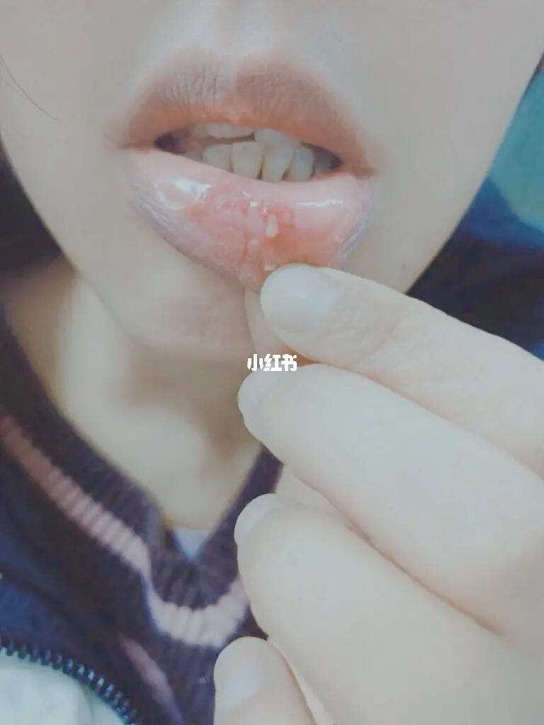 口腔溃疡你分得清吗？