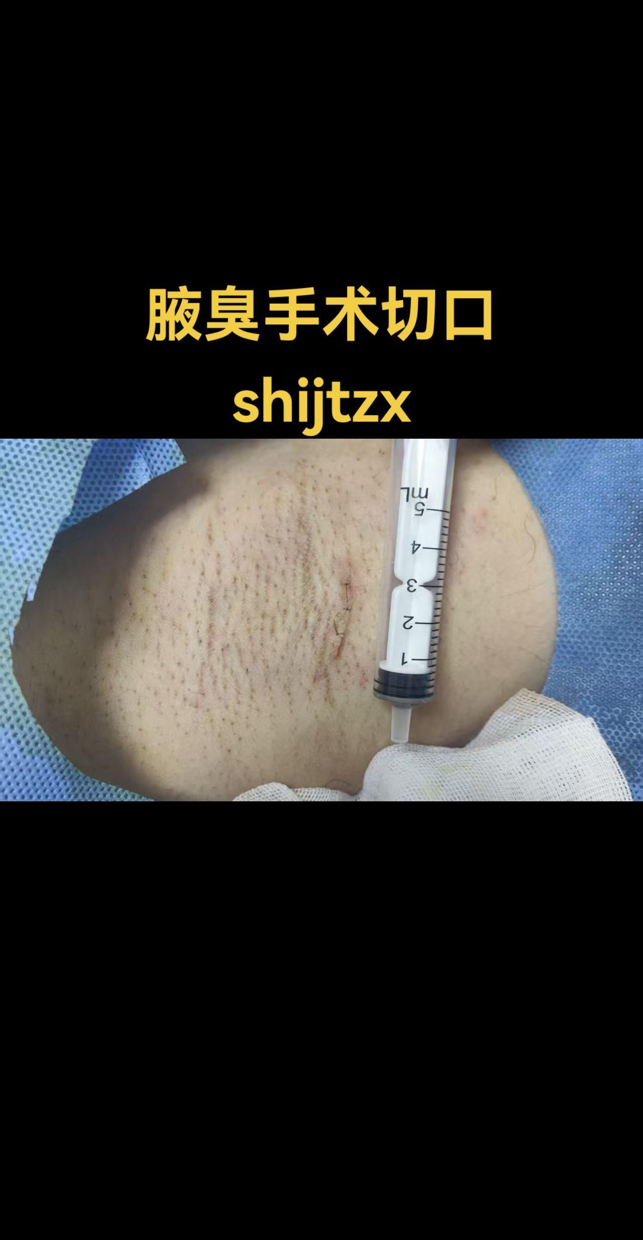 腋臭小切口手术。腋臭手术的小切口和大汗腺清除手术技能要并重。