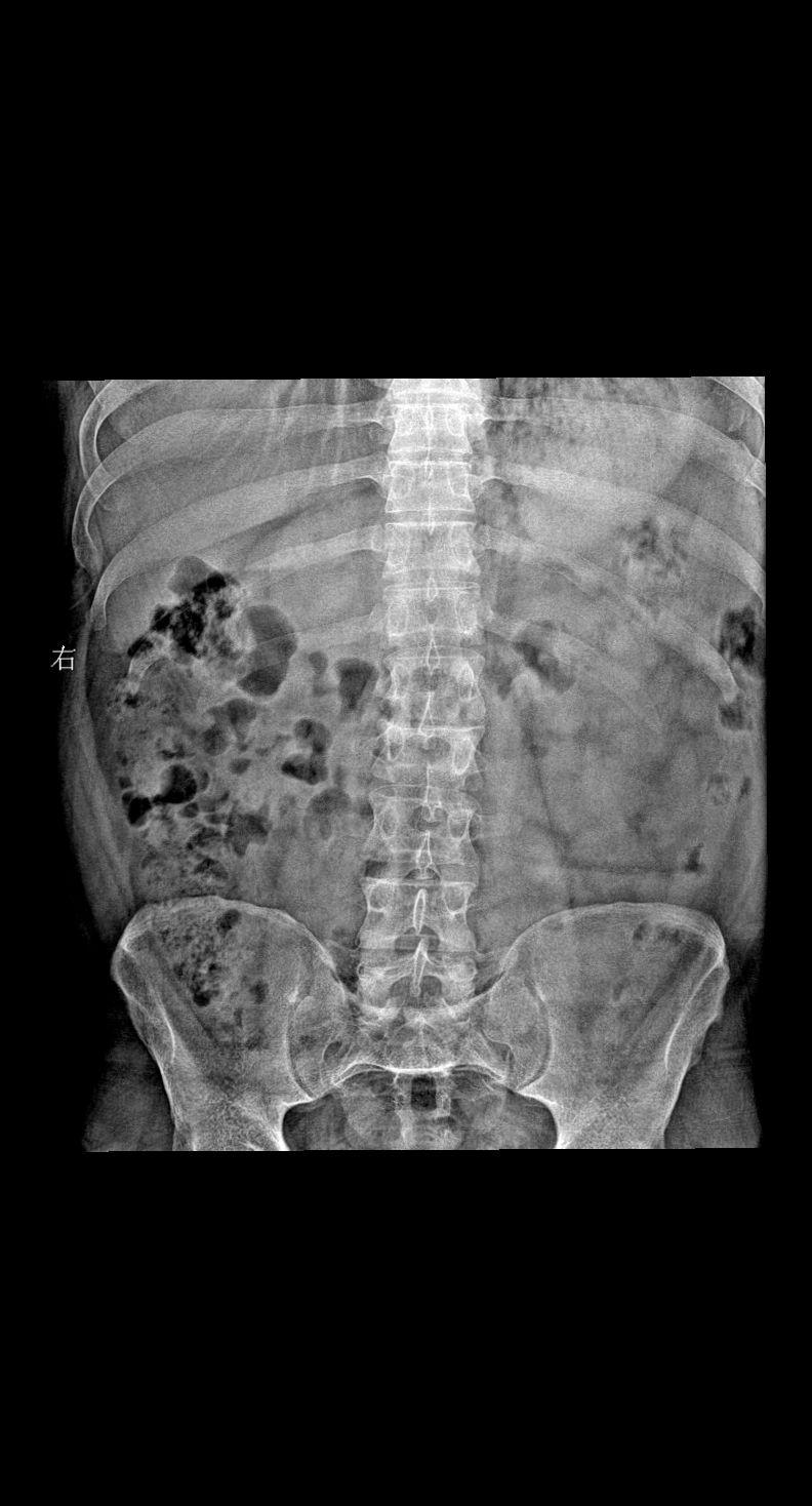 男 36岁 外伤 腰椎正侧位