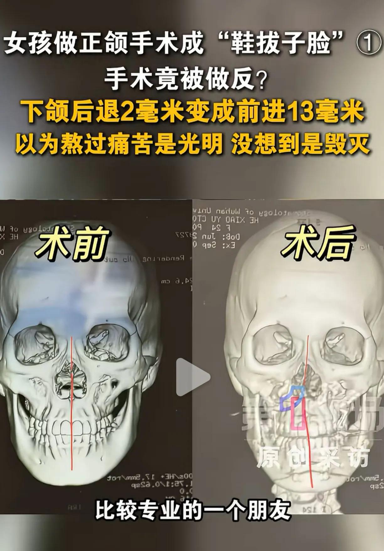 资深的正颌专家，没带来美丽，却带来了巨额花费的灾难！美丽究竟谁来买单？
“鞋拔子