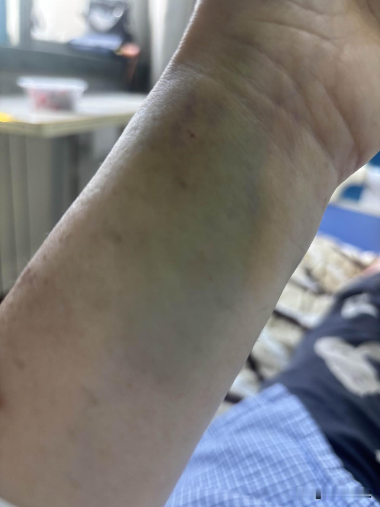 就说，遭不遭罪吧，两只手被扎成这样。
两只手是在手术室扎成这样的，好像是为了扎静