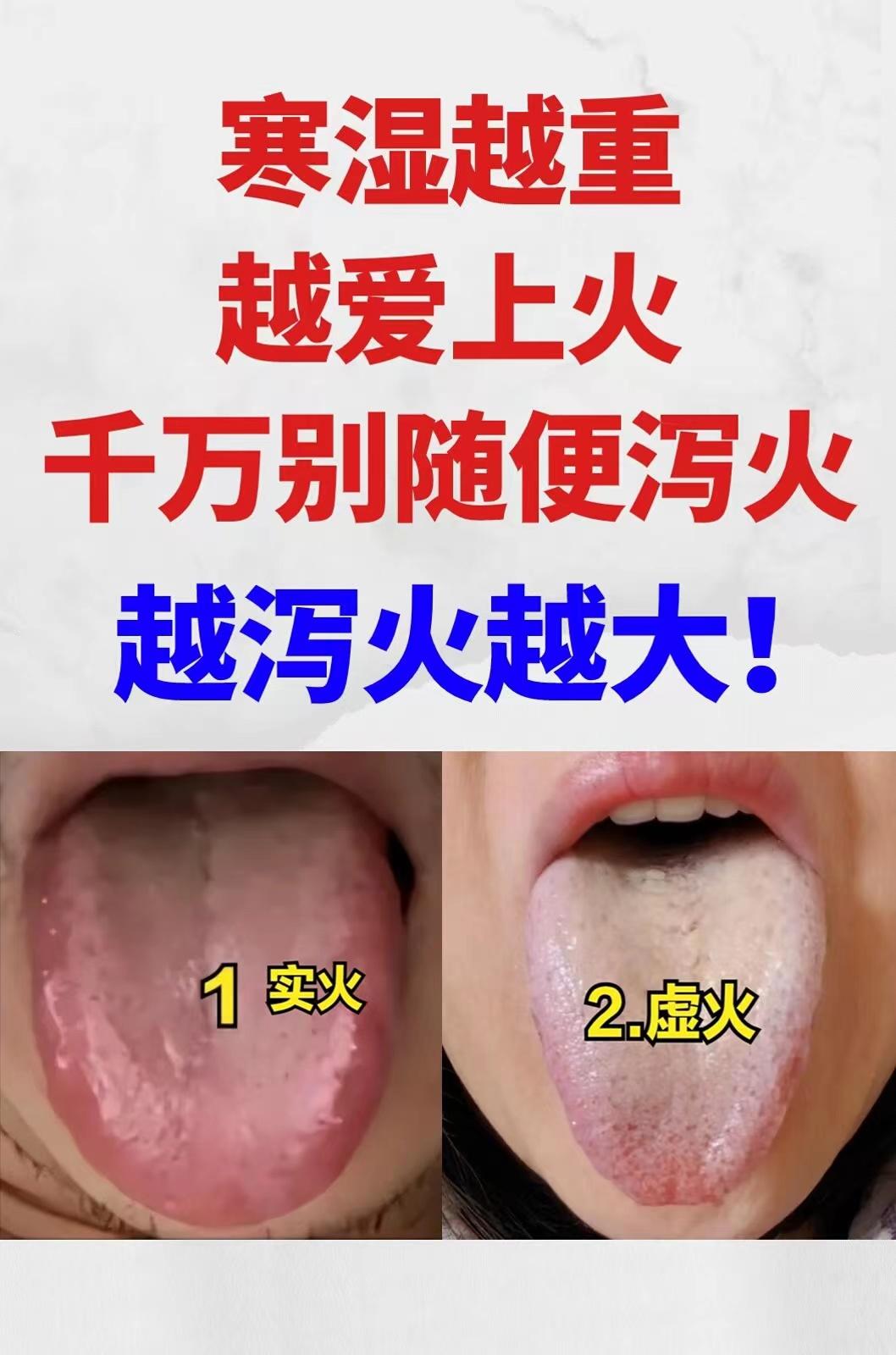 寒湿越重，越爱上火，千万别随便泻火，否则越泻火越大[加油][中国赞][中国赞]
