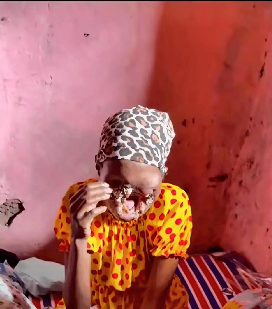 她脸没了，只剩骨架。
这哪是病，简直是人间酷刑。
网友：这得有多痛，才能熬过来？