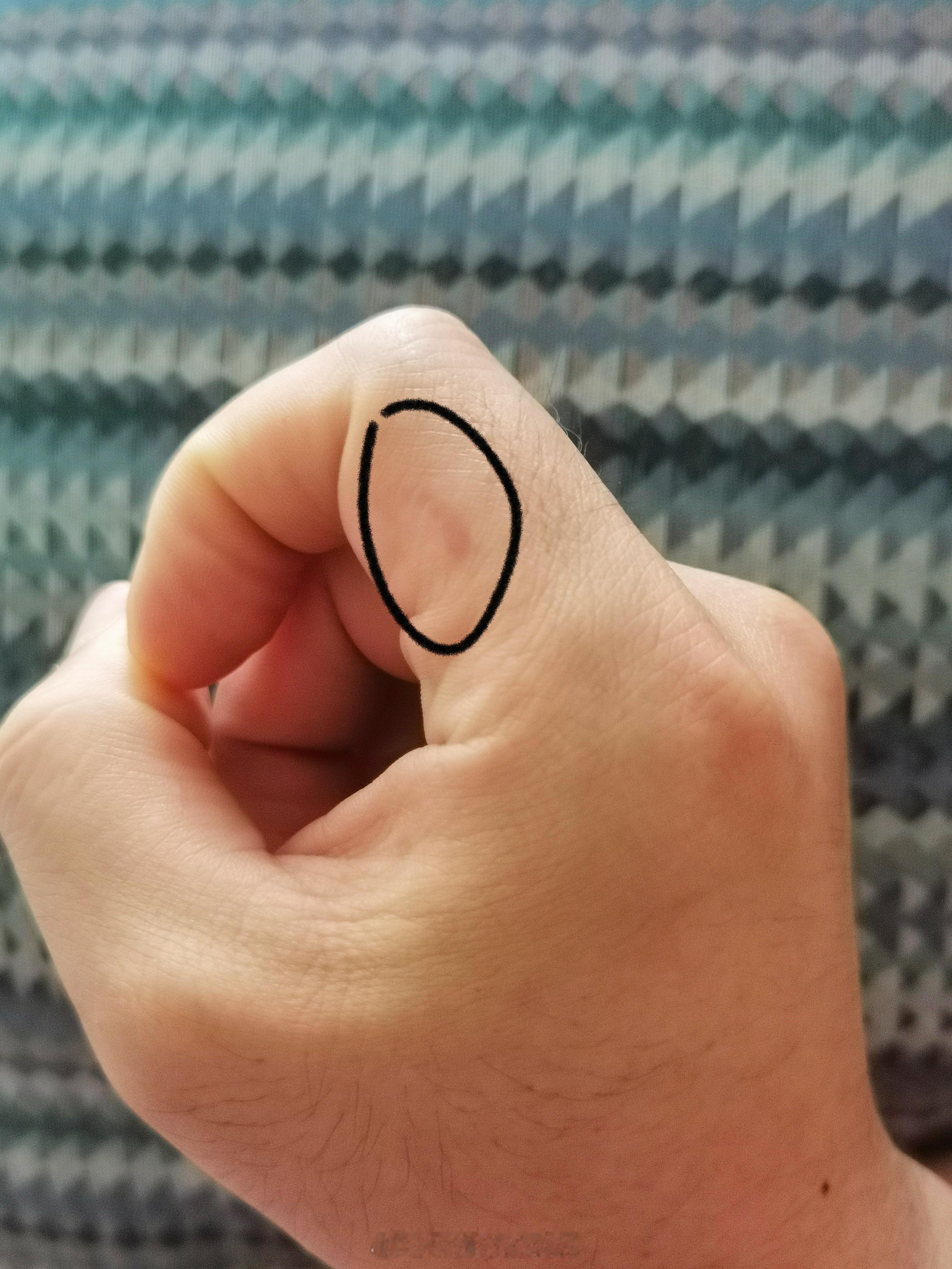 #吃达美乐被烫成二度烧伤#撇开达美乐和这位女士谁对谁错，二度烧伤也分浅二度和深二