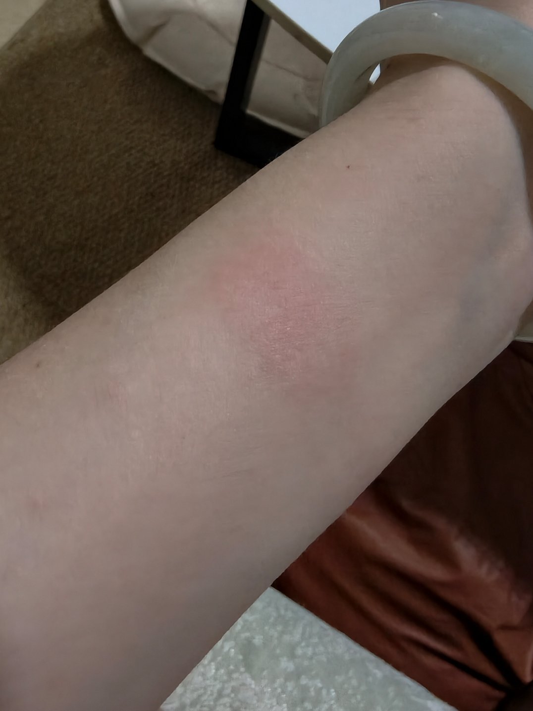 运动手环 皮炎我一直以为是过敏来着，会红会痒，特别是硅胶表带，所以一般只在睡觉时