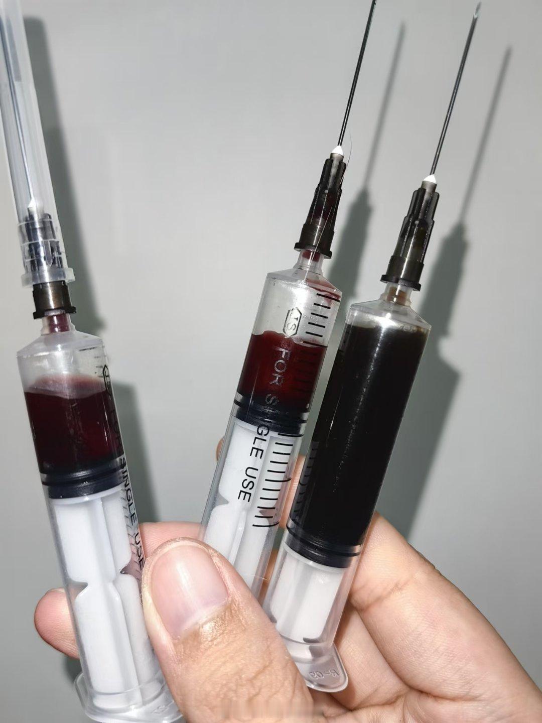 中高分化的腺细胞癌，苏州卓越宠物医院。细胞学太漂亮了。  ​​​