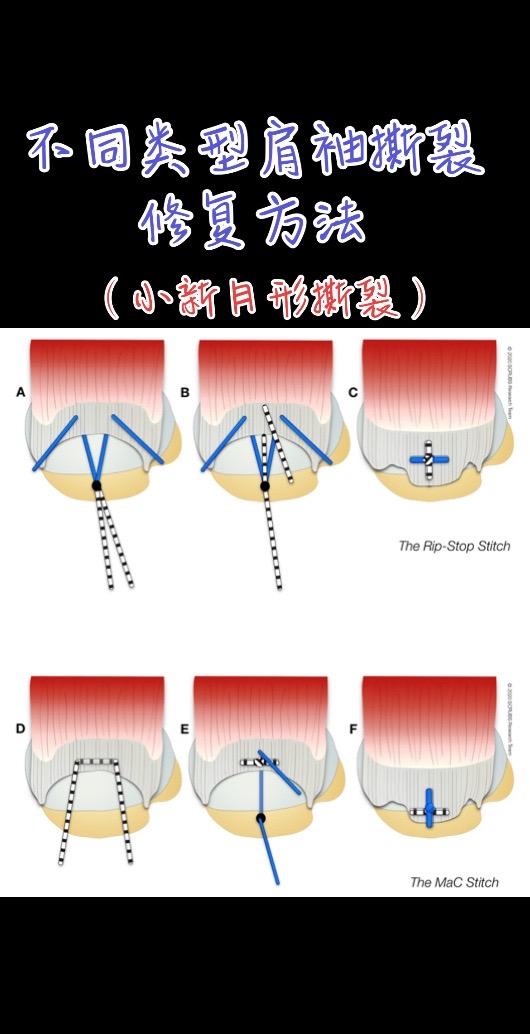 不同类型肩袖修复技术。修复要求：尽可能解剖，低张力。Journal o...