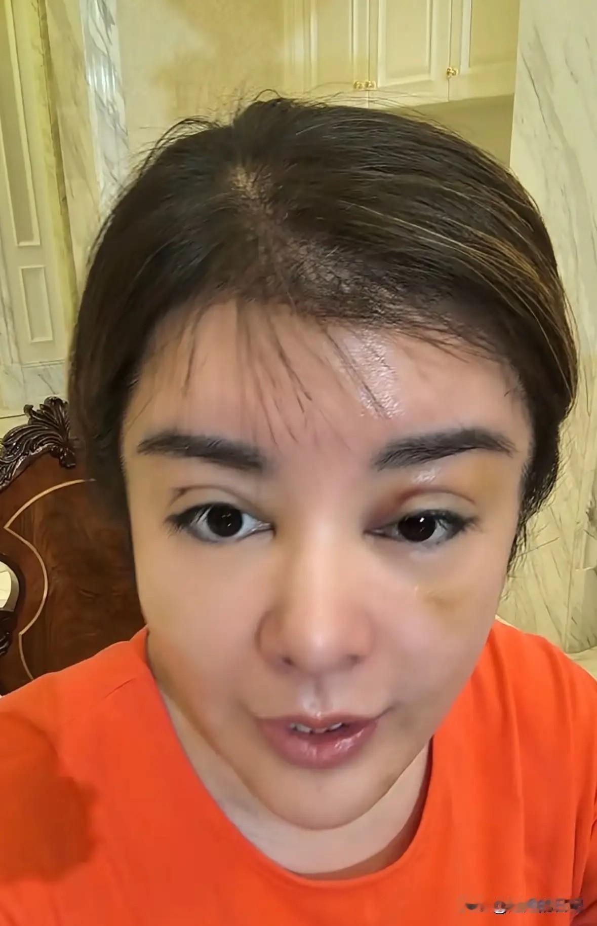 于文红太吓人了，这是在作妖吧，换小男友，作整容，而且越来越吓人，

这大双眼皮，