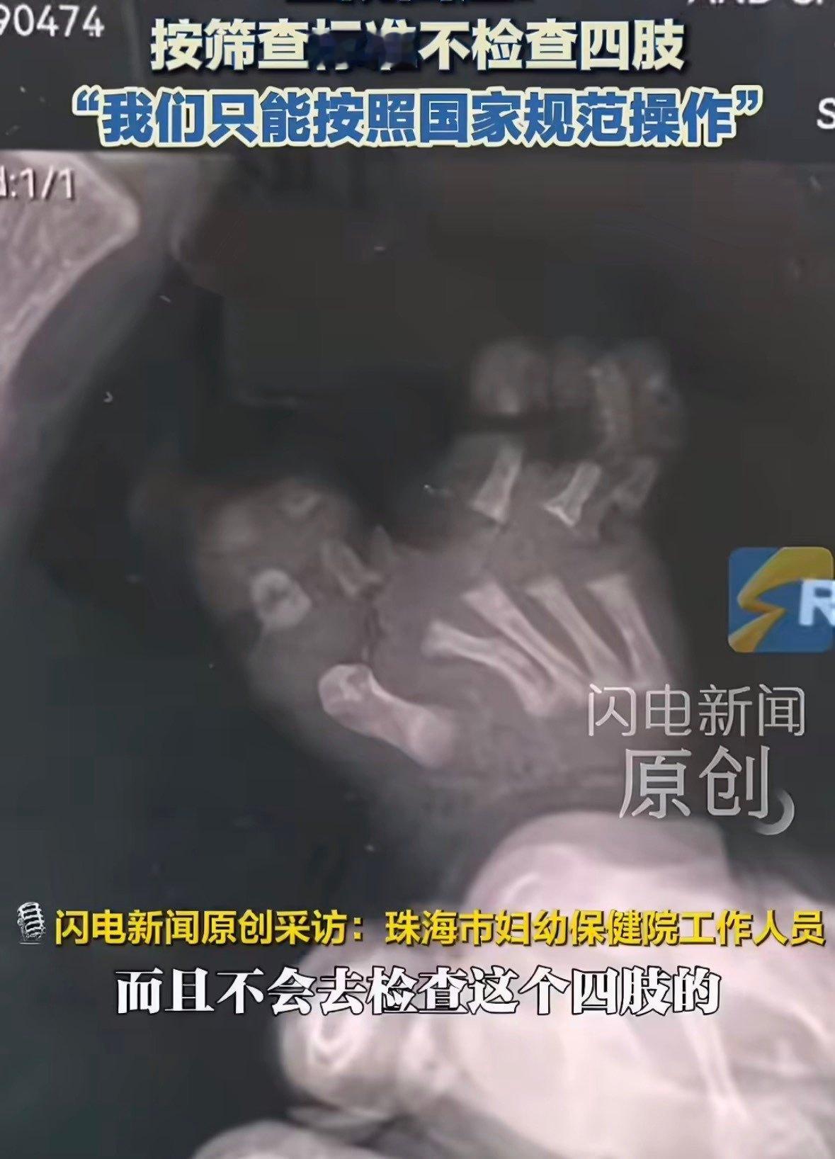 花一万多产检一路绿灯生下来畸形特意去查了一下，原来很多所谓的大排畸根本就不排查手