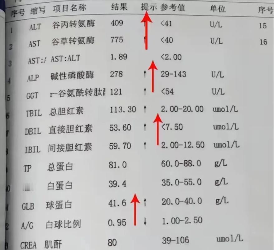 肝功能检查只要这5项正常，你的肝脏基本无大碍

谷丙转氨酶（ALT）：ALT是肝