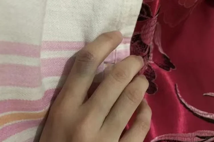 手指关节突然青紫图片