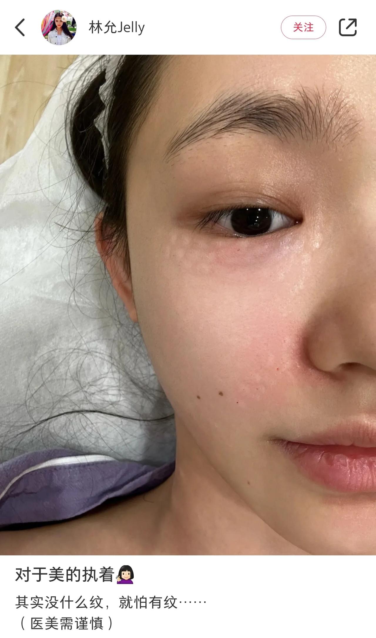 林允晒自己做医美的照片，上面密密麻麻的针眼痕迹触目惊心。
好奇女明星为什么这么拼