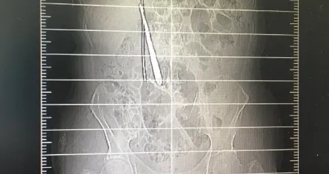 【湖北】郑州男子腹痛难忍，检查发现肠子里有3根近15厘米长金属条，咋回事？