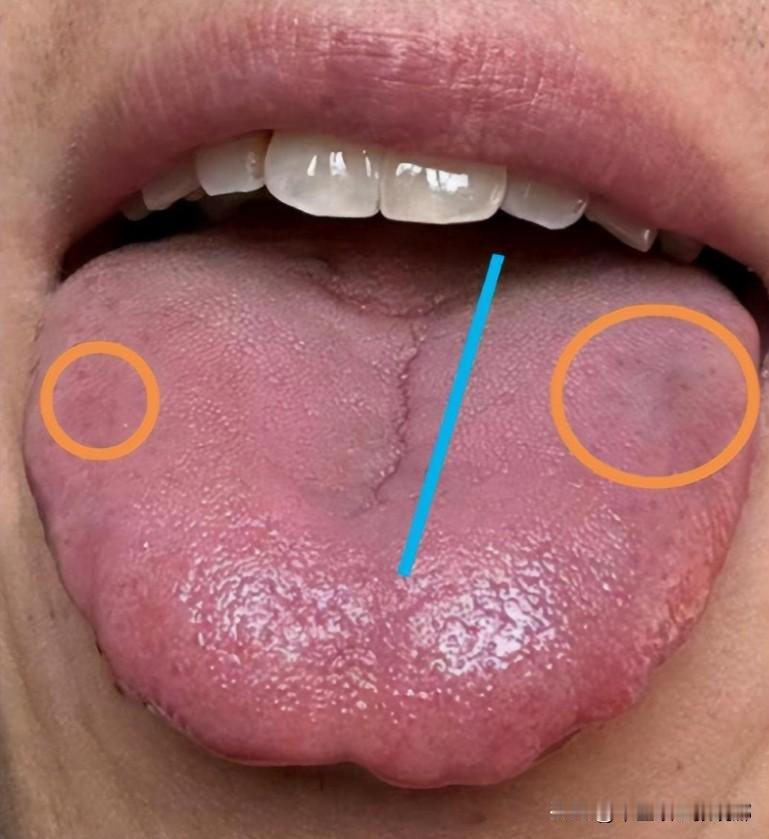 活血化瘀——血府逐瘀丸、少腹逐瘀、还是桂枝茯苓丸？中医根据舌象告诉你

1、血府