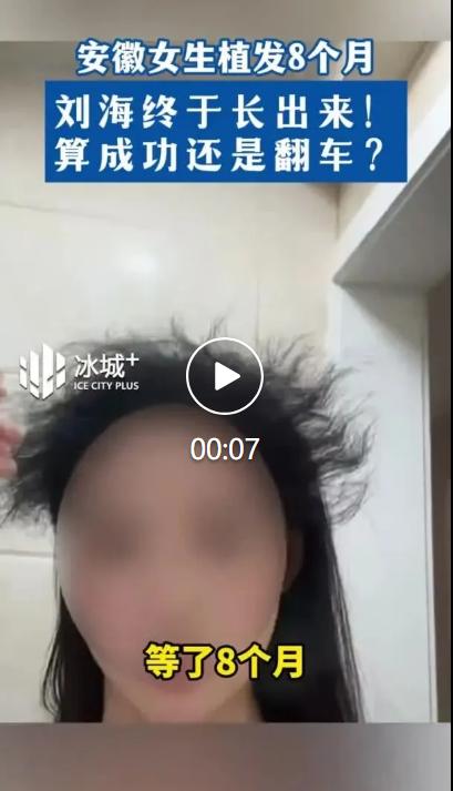 最近安徽一位女生晒出自己的植发近况，做完发际线和刘海植发整整八个月，期待已久的刘