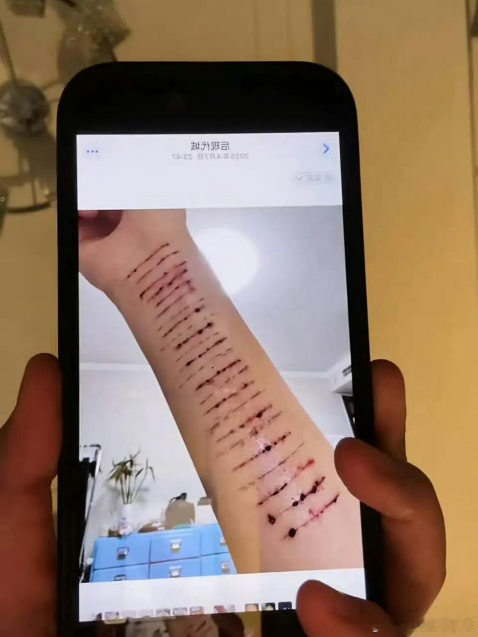 我去 金子涵发了求救文字 也晒了手臂伤口 太可怕了 但也否定了与秦岚有关金子涵否