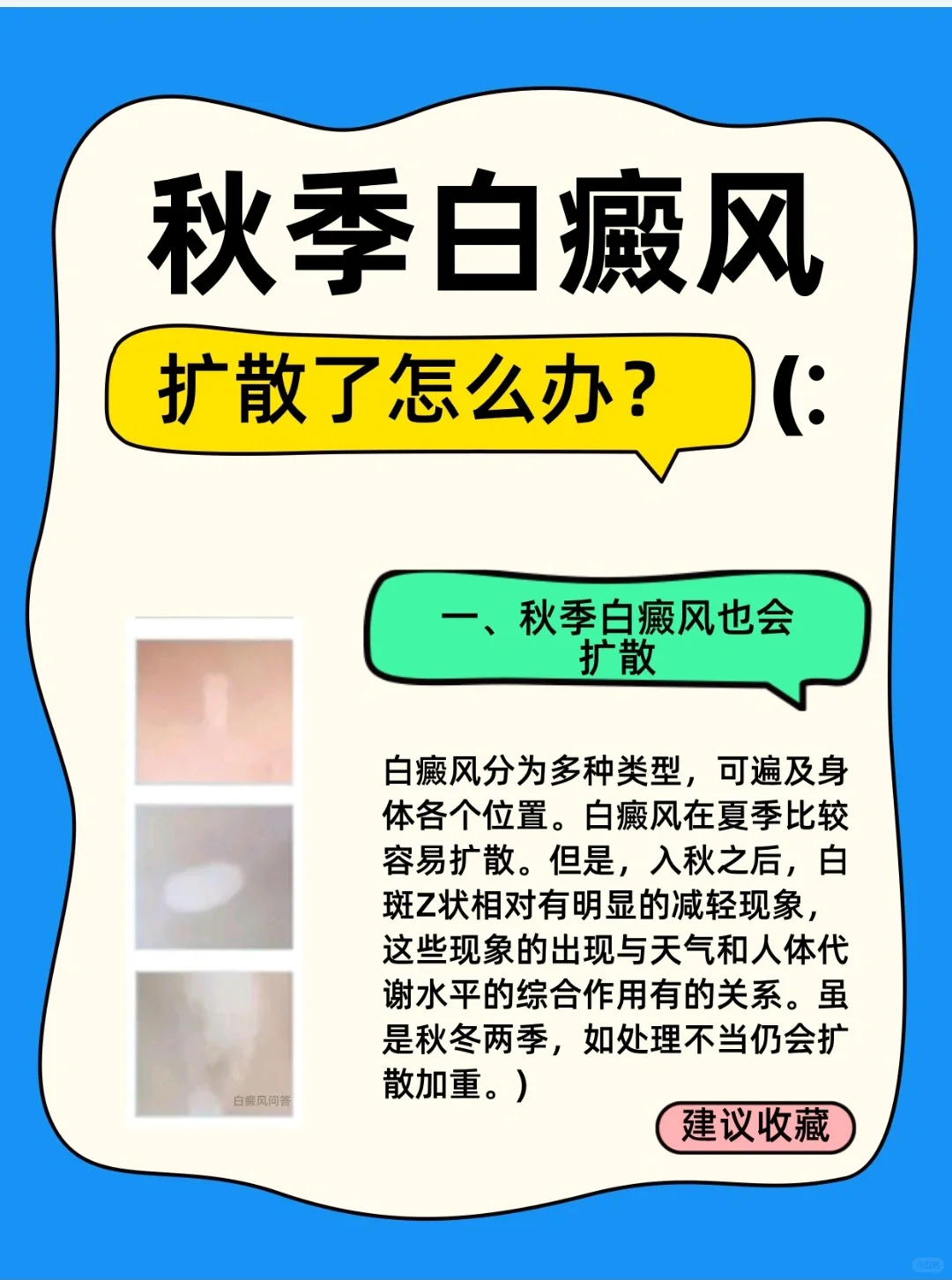 秋季白癜风扩散了怎么办？应该注意些什么❓