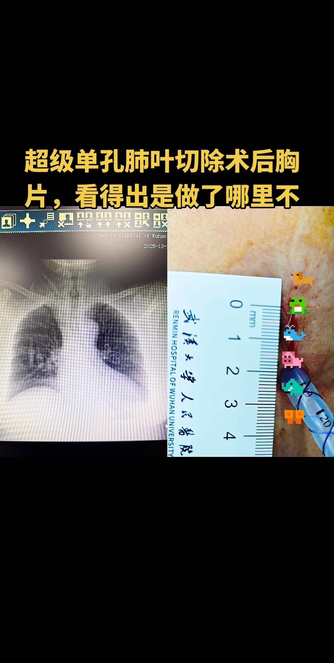 2厘米级别单孔肺叶切除。术后胸片看不出哪里做了手术，完美