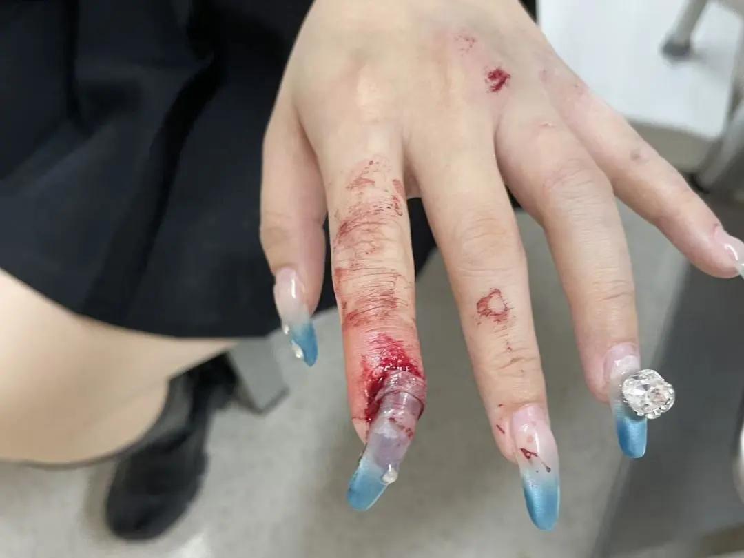 浙江杭州，一女子因美甲太长，在搬重物时，把指甲掀开了，最后指甲变黑坏死，反复感染