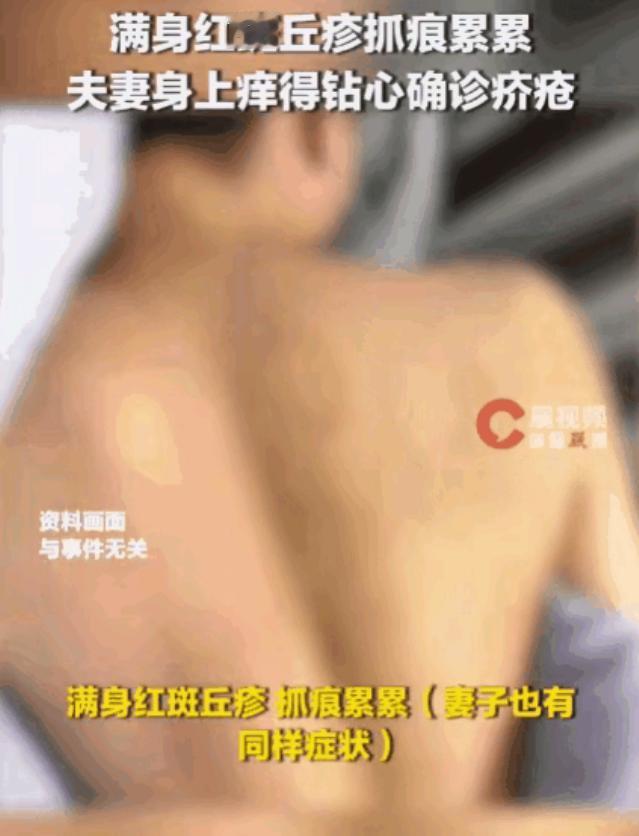 “不要盲目相信自己的判断！”福建，一名男子在朋友家住了几天，回家后肚子、大腿痒得