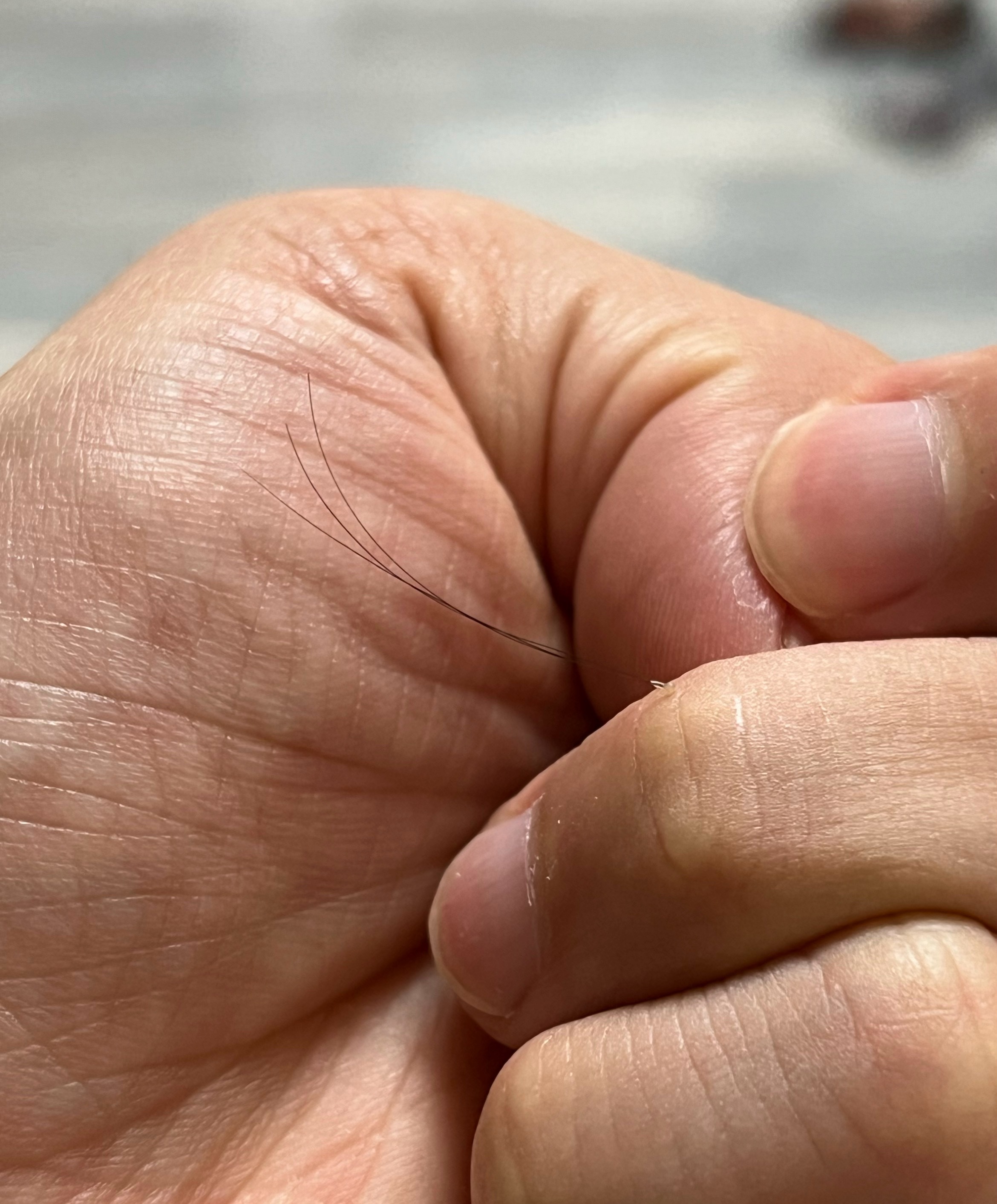 我现在格外惜发刚才一挠头，掉下来一撮一个毛囊里面三根掉了，心痛