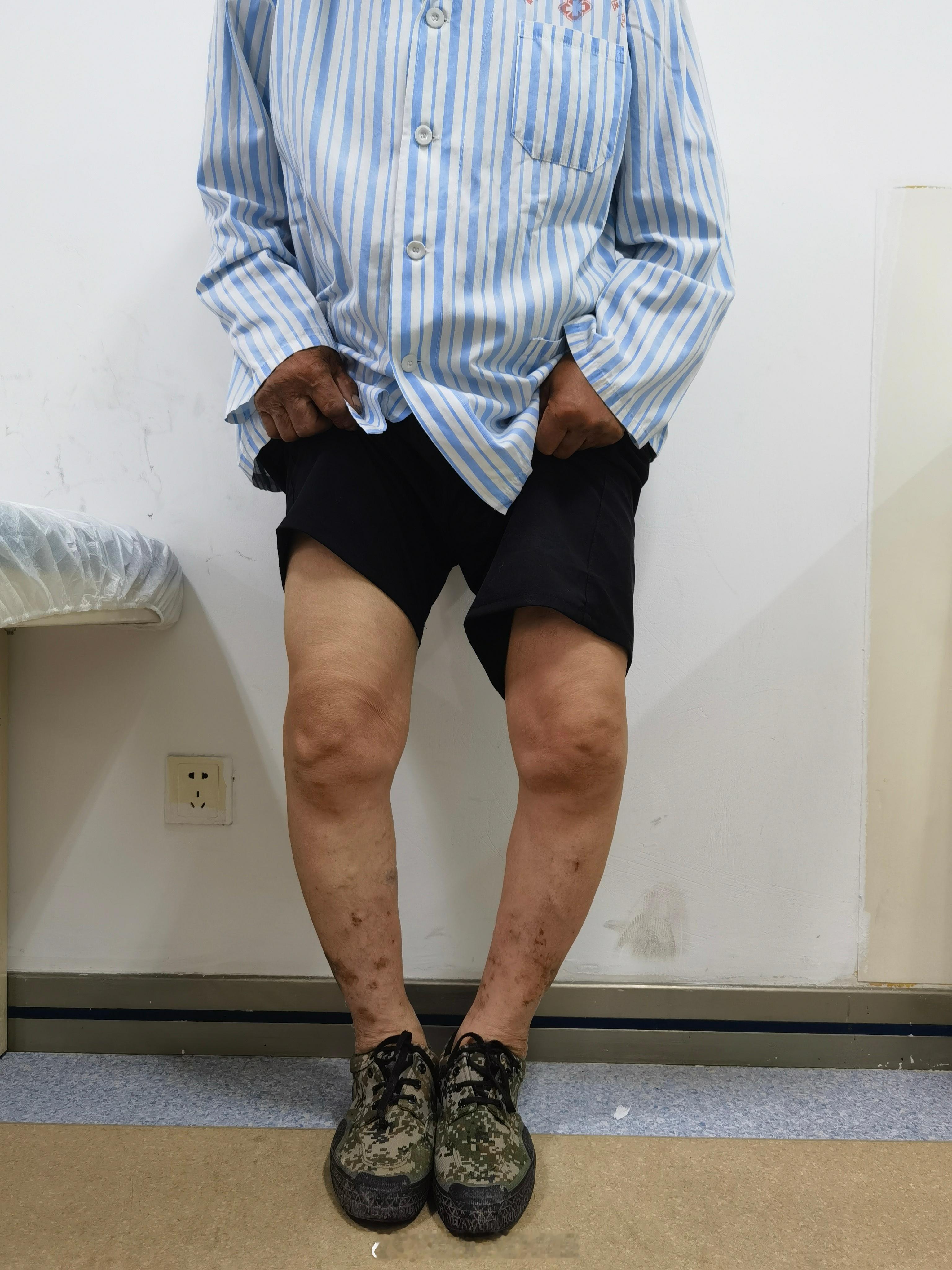 重度内翻膝，都O型腿这样了才来手术… ​​​