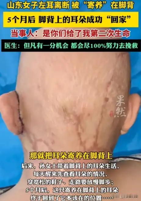 实施这台神奇手术的是山东第一医科大学附属省立医院手足与显微重建外科仇申强团队 。