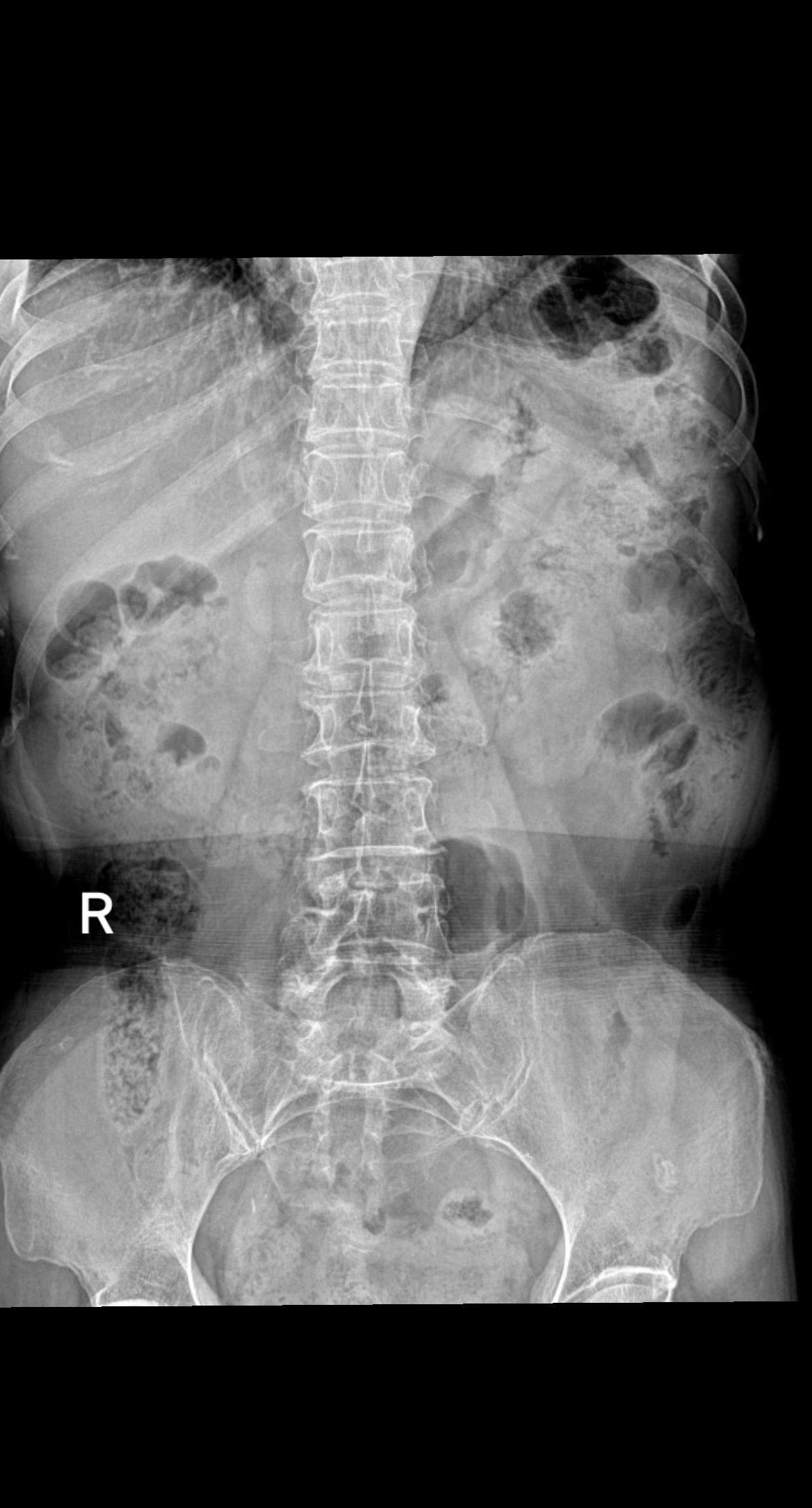 腰椎疼痛，下肢麻木酸疼