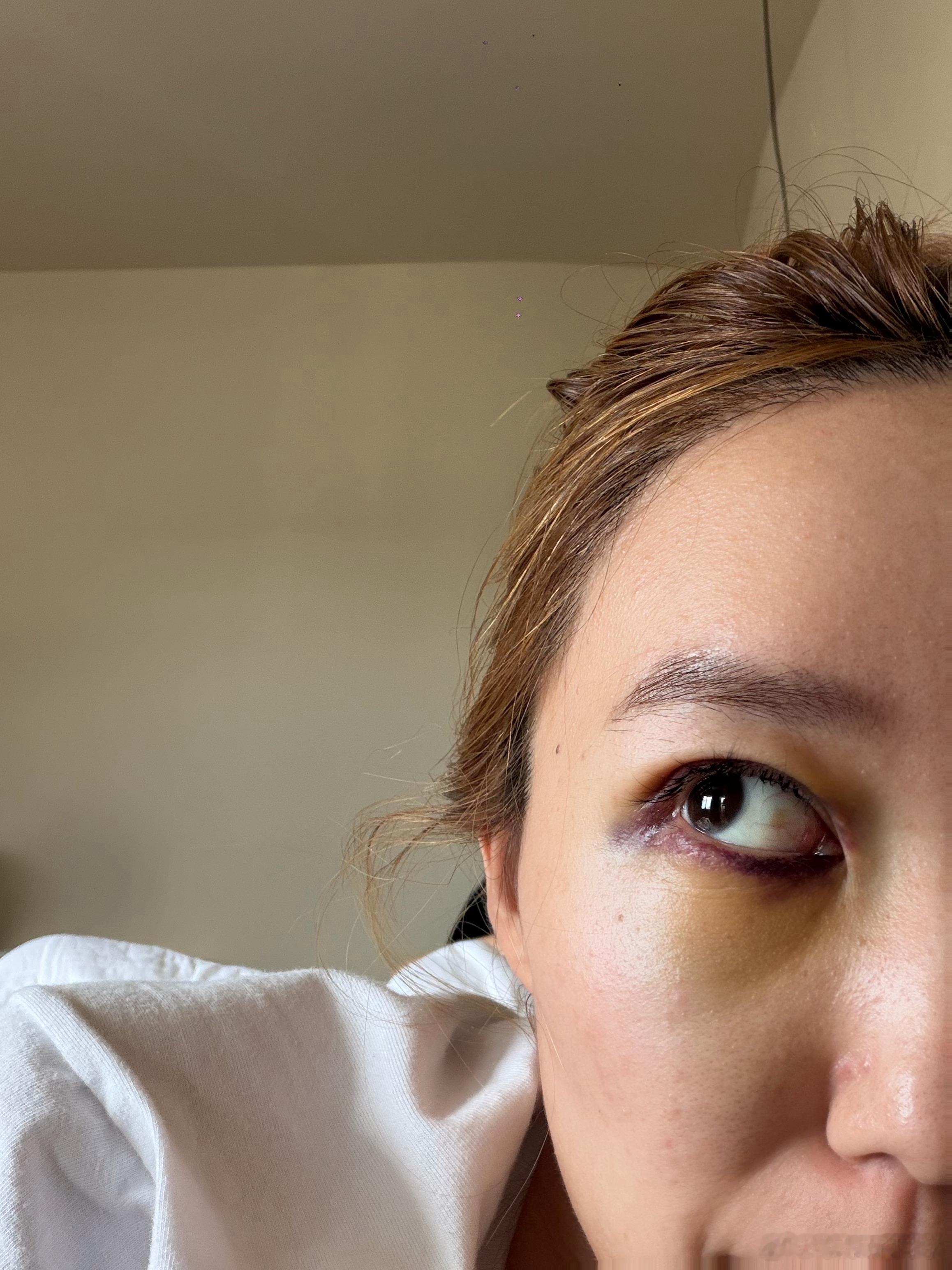 求求了，淤青什么时候可以消掉，临时取消了好几个拍摄，可是发现后面还有一堆拍摄呢[