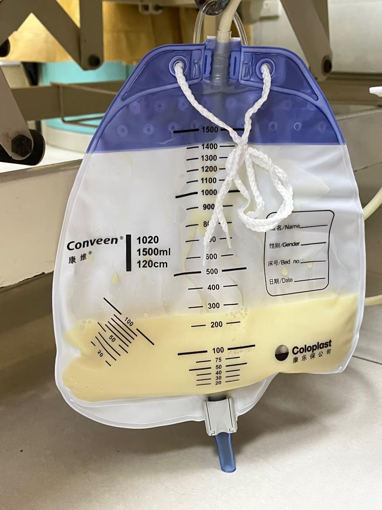 山东枣庄45岁乙肝肝硬化患者，肚子胀得快要爆炸了，肚脐外翻，B超一测腹...