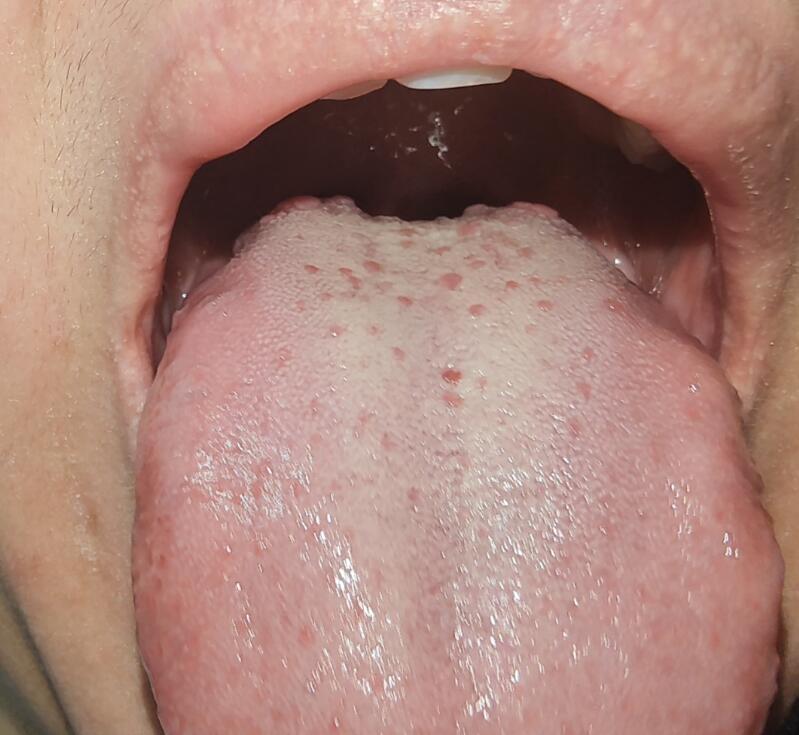 看舌头根部，就是看男科！这么多小疙瘩，你觉得你房事强到哪去？

昨天遇到的一位病