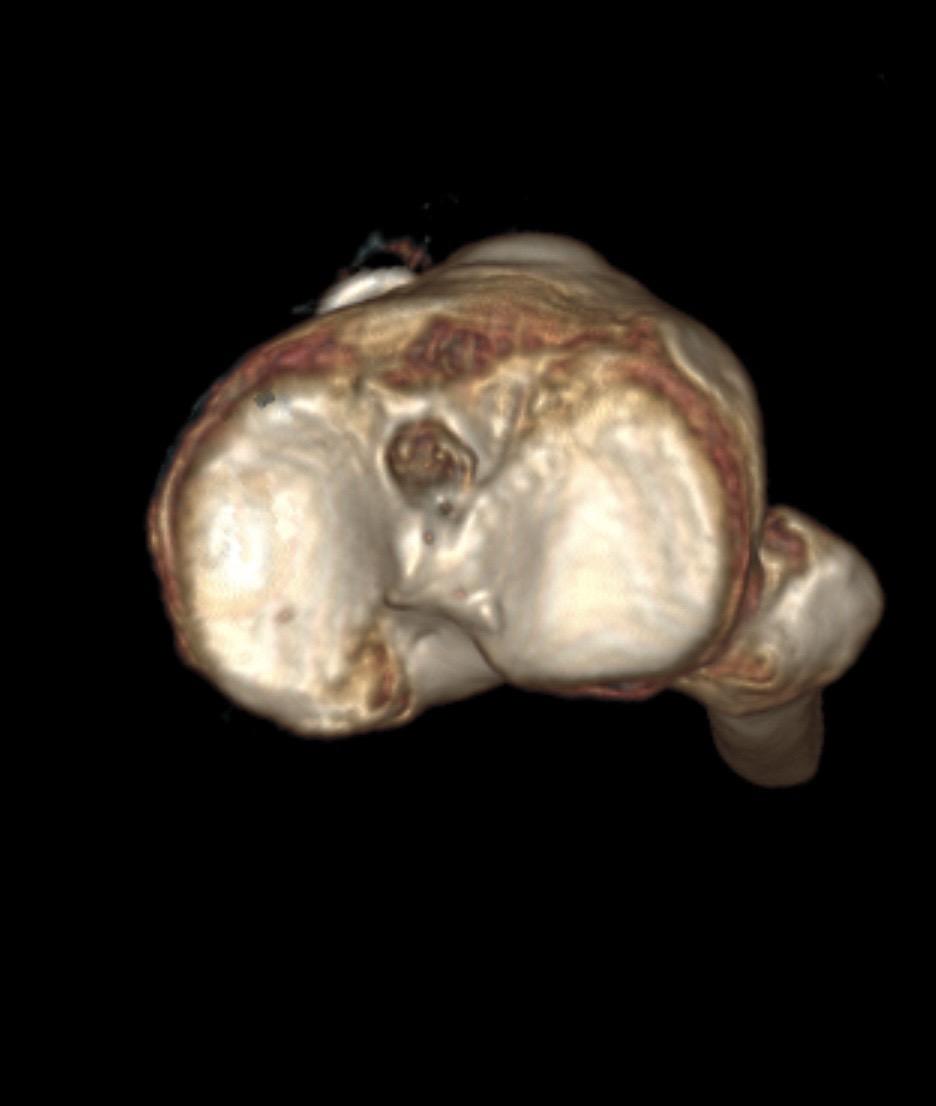 前交叉韧带重建。前叉重建+半月板修复，祝他早日康复！