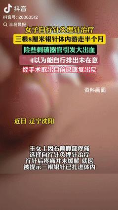 无知很可怕！6月10日，辽宁，女子自学针灸后给自己埋针治疗，不料三根8厘米的银针