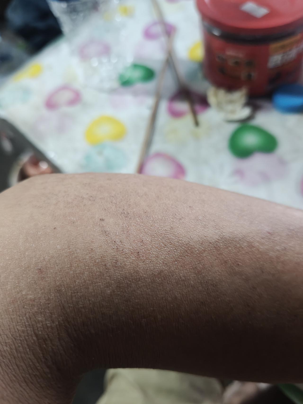 有时候你不服原研药不行，像我身上起了一堆疙瘩，特别是到了晚上痒得不行，只能穿着衣