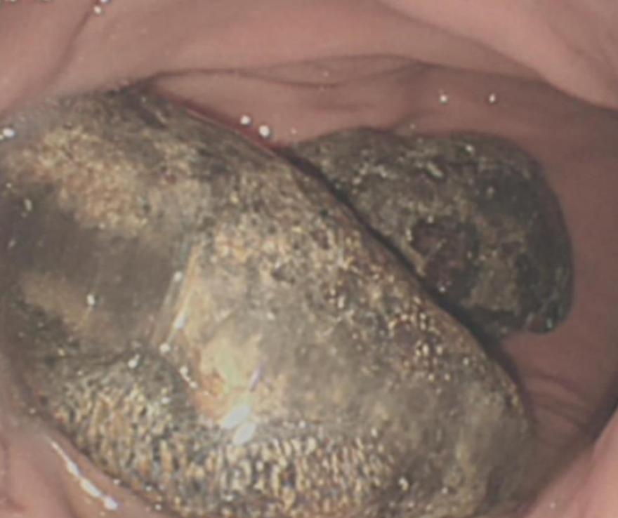 惊！女子吃1米长冰糖葫芦胃里长出“巨石”，到底怎么回事？

大家好，今天来聊聊那