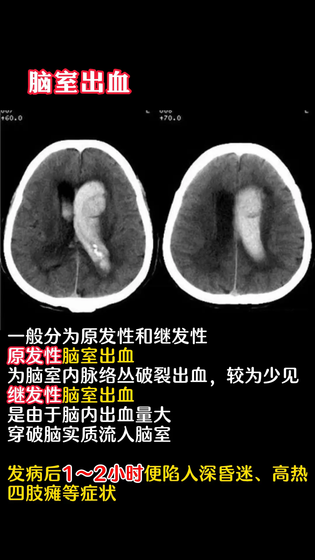 6种不同部位脑出血影像及临床表现。
