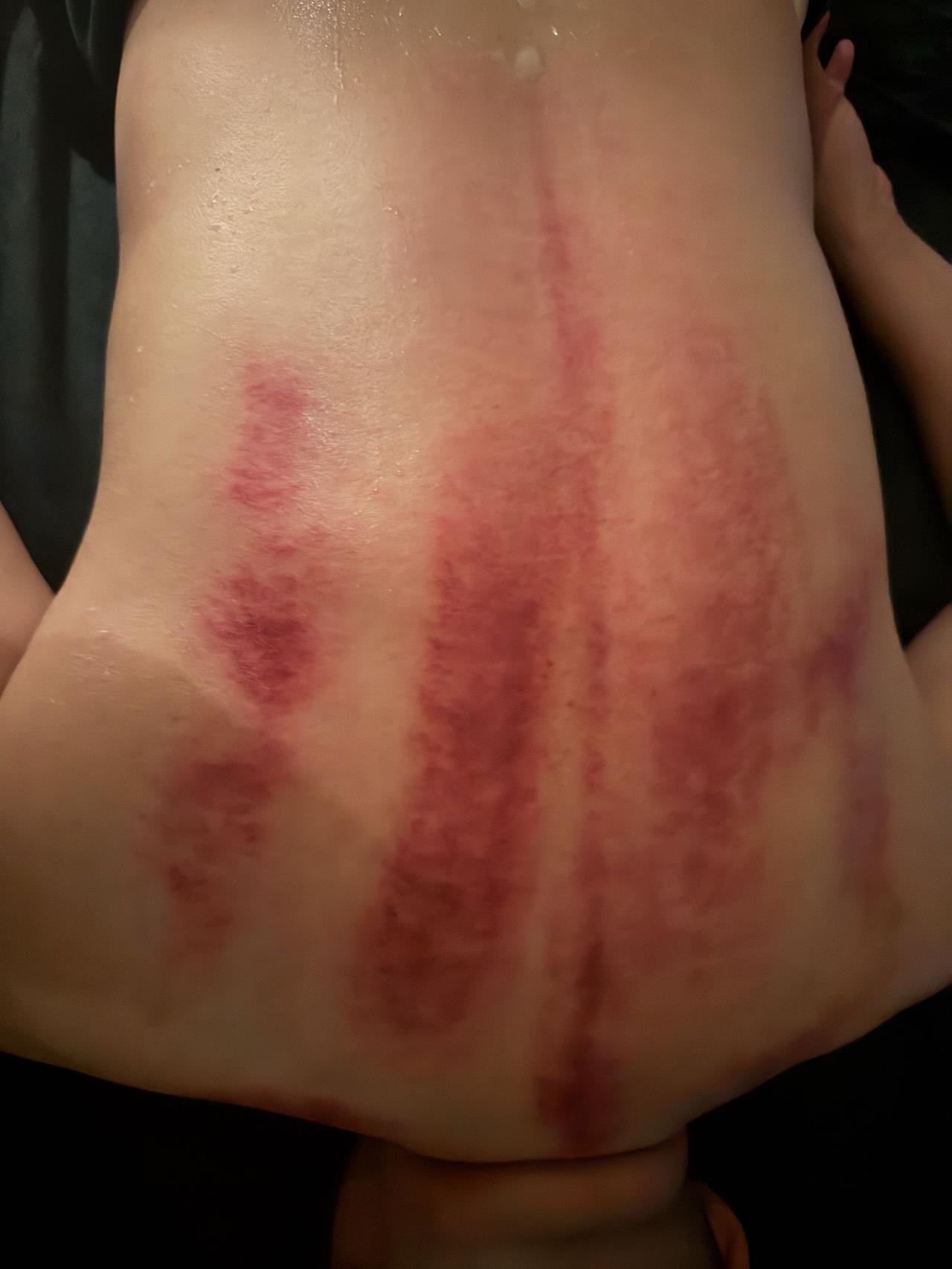 昨晚辗转难眠，便打算约一位平素爱喝酒的男性朋友小酌一番。结果他说昨天下午刚刮了痧