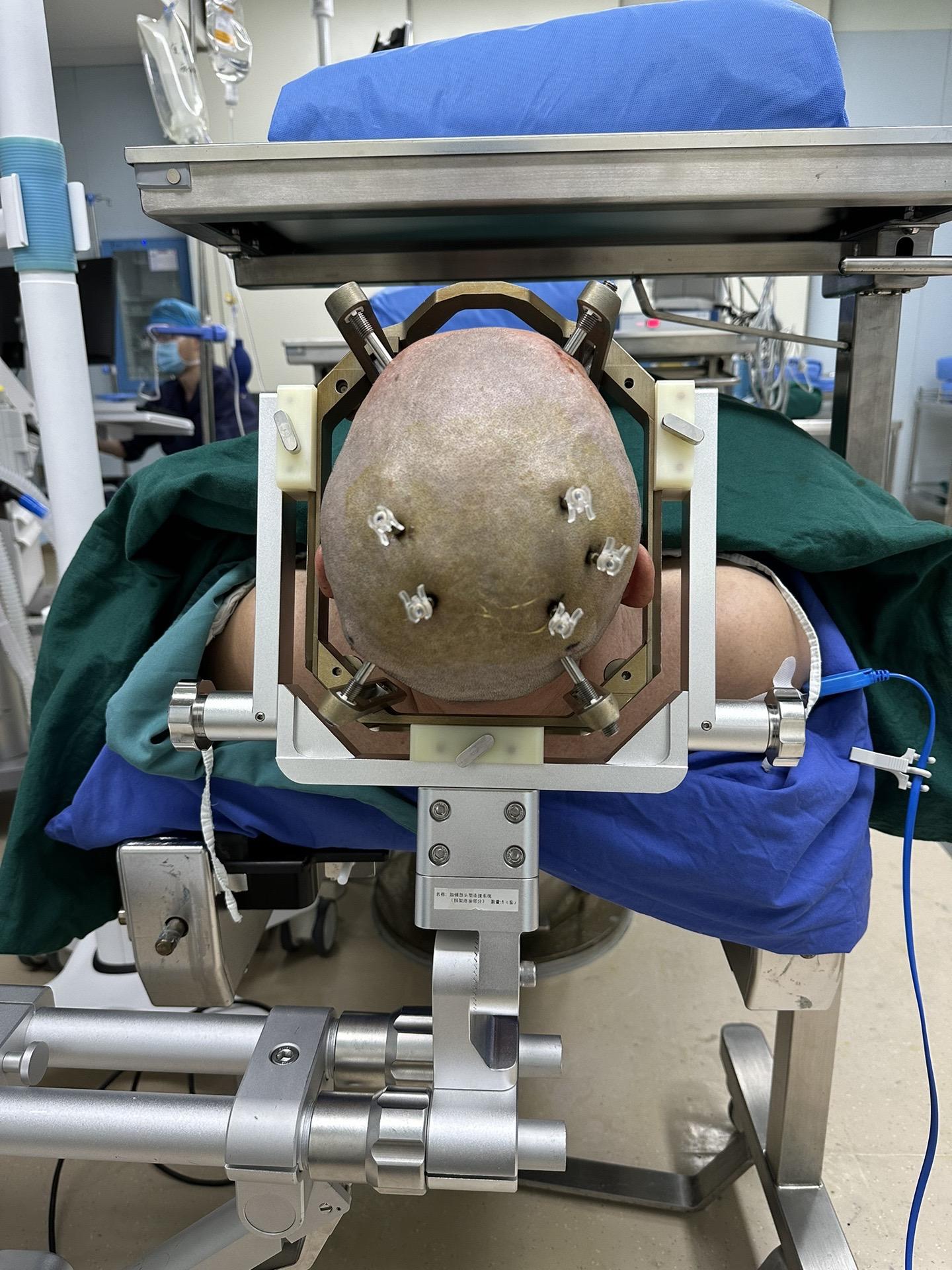 帕金森病-机器人辅助手术。帕金森病由于需要精准植入，常采用立体定向框架或者机器人来精准制导，且手术需要人员较多！