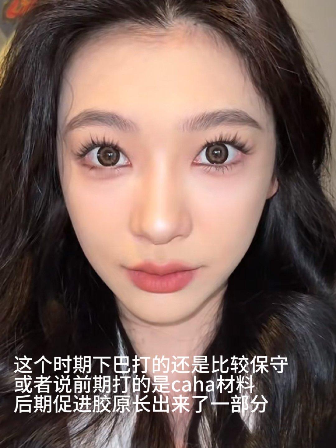 全网都在拆解 yml 的变美思路，从鼻子额头眉弓，我觉得她变化最大的是她的整个下
