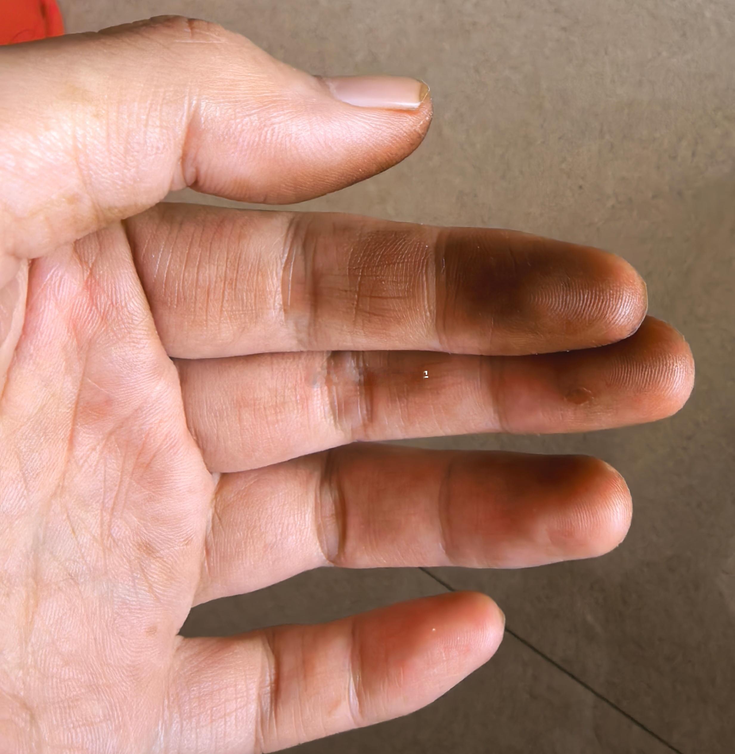 昨天下午摘青皮核桃吃，这就是代价，两只洗不掉的黑手！ ​​​