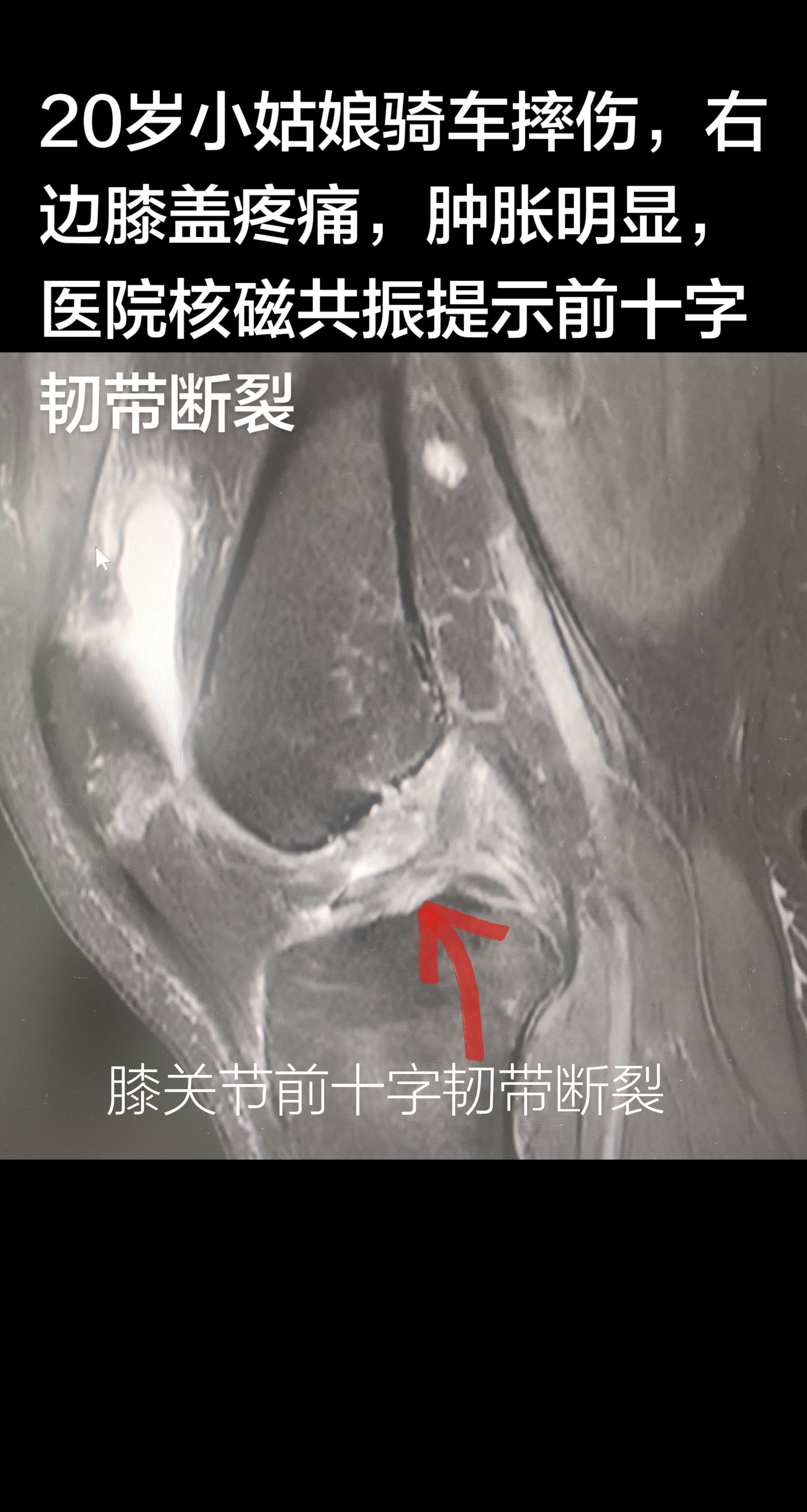 膝关节十字韧带断裂。
