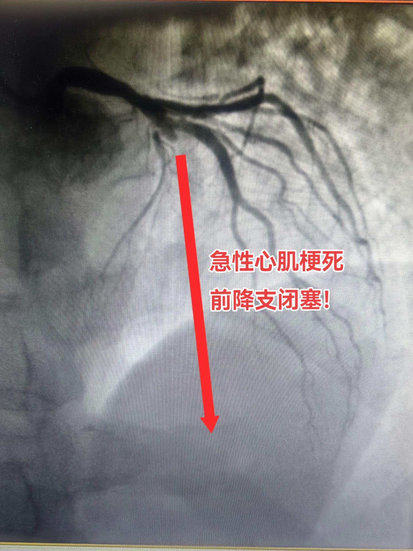 急性心肌梗死