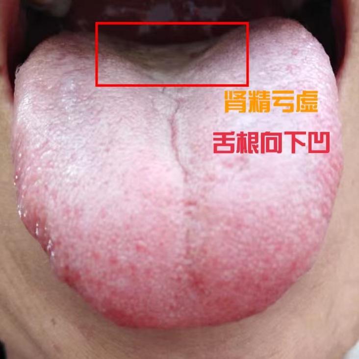 五子衍宗丸 金锁固精丸都补肾精，怎么选？我来教你
这两个药的名字相信大家都不陌生