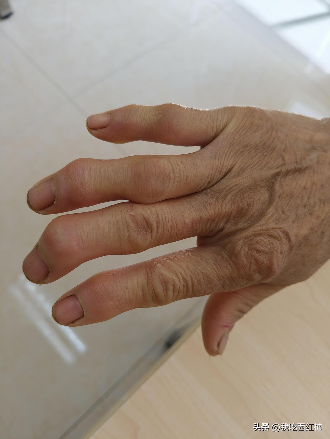 一起上班的阿姨手变成了这样
她说去医院检查手指，医生问她有没有风湿，但是去年检查