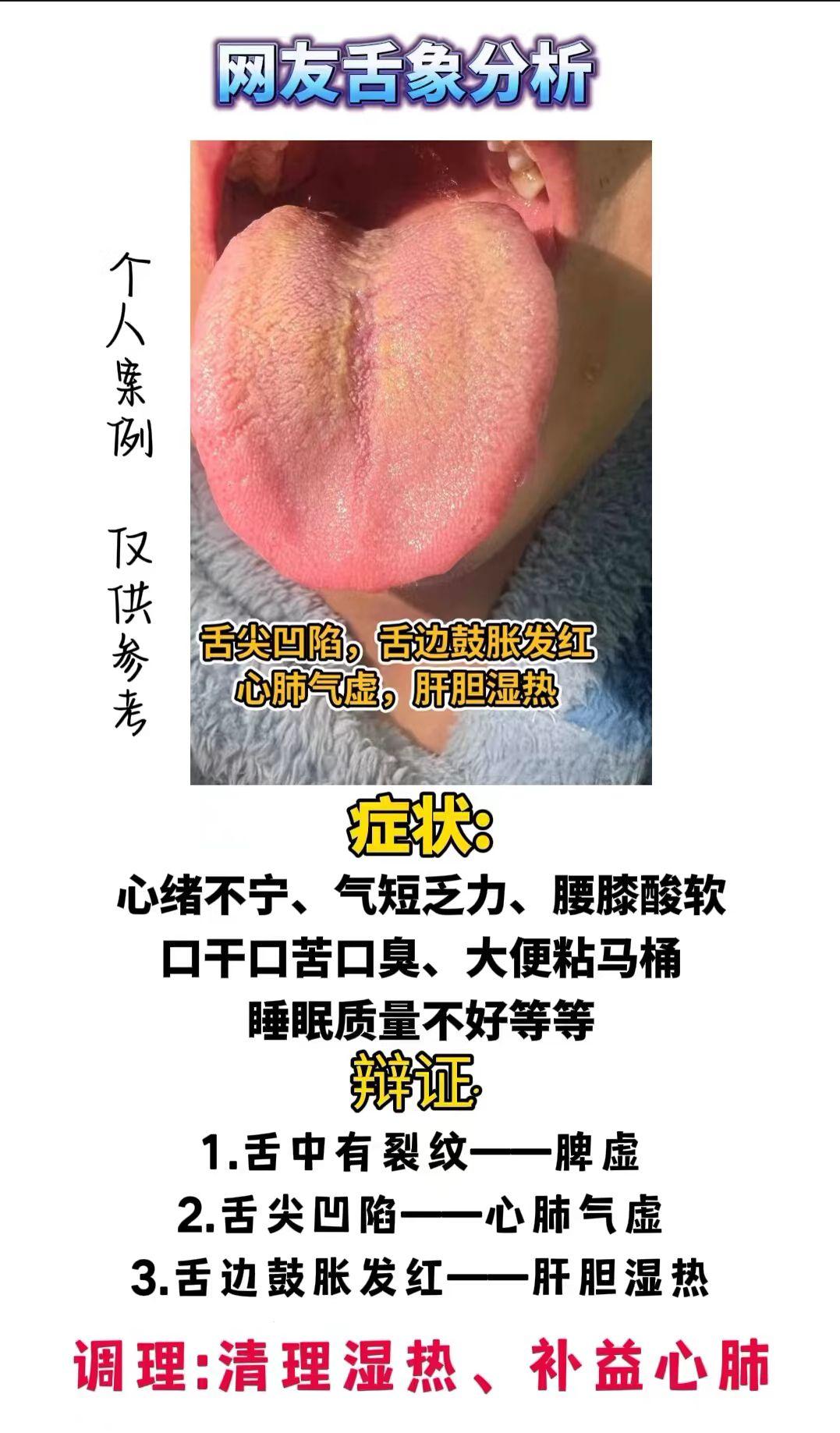 腰膝酸软 脾气暴躁 口干口苦 看看你的舌象是哪种