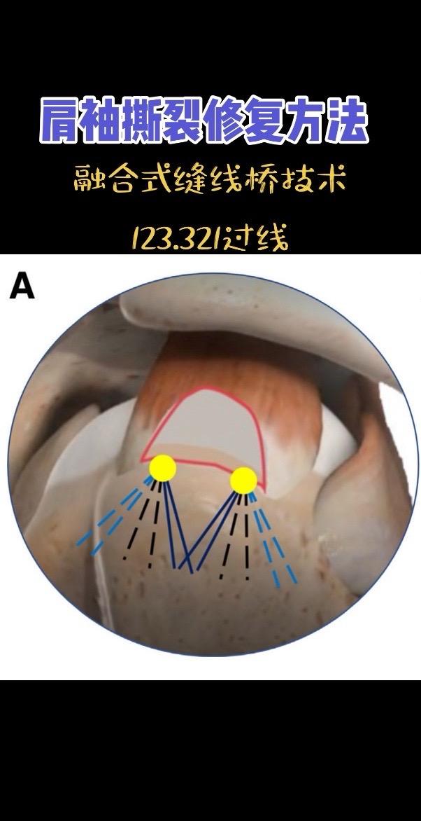 肩袖撕裂修复方法。融合式缝线桥技术