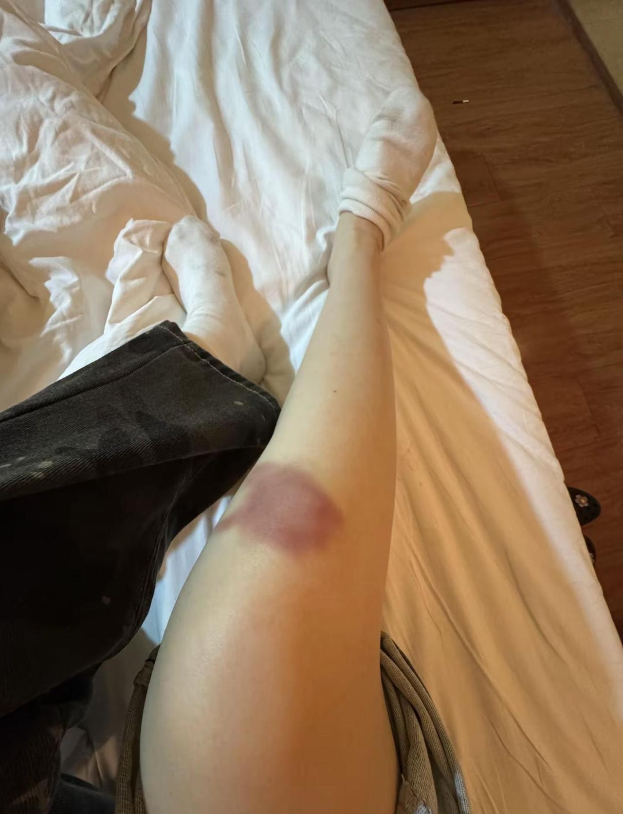我原来不是这样的 腿青了是我自己没站稳摔的 腿破皮了也是我自己跪在马路中间自己卡