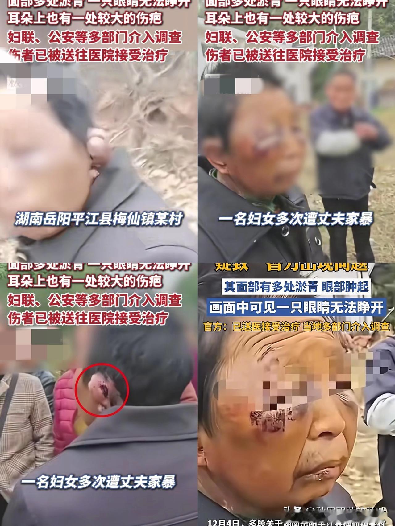 结婚前一定要擦亮眼睛！

湖南女子遭丈夫多次殴打

被人送往医院救治，出院后丈夫